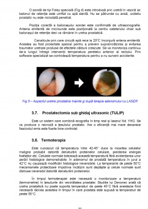 adenomul de prostata referata
